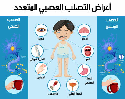 أعراض التصلب العصبي المتعدد