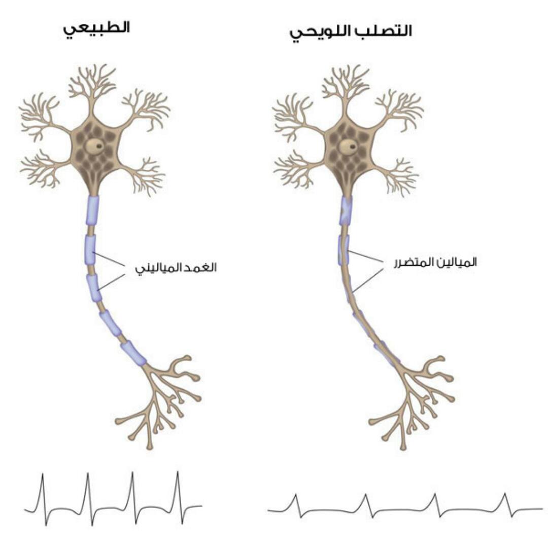 الفرق بين الأعصاب المصابة بـ التصلب المتعدد والأعصاب الطبيعية