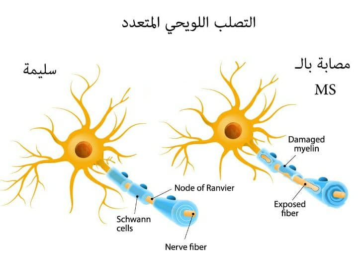 الفرق بين الأعصاب المصابة بـ التصلب المتعدد والأعصاب الطبيعية