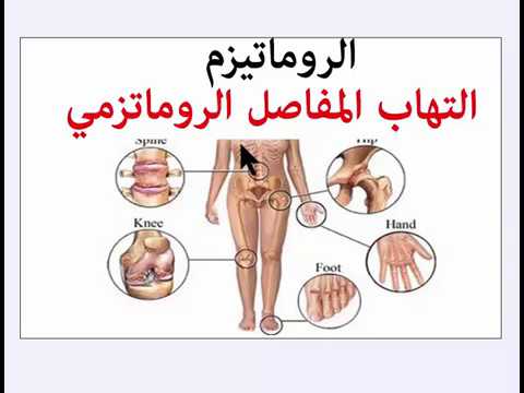 علاج أعراض التهابات المفاصل والروماتيزم