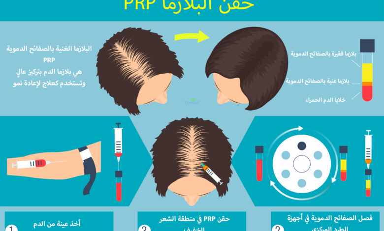 ما هي حقن البلازما PRP ؟