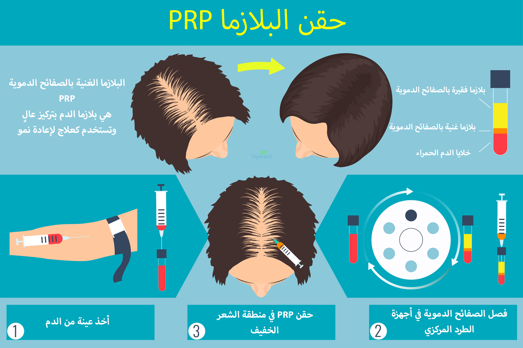 ما هي حقن البلازما PRP ؟