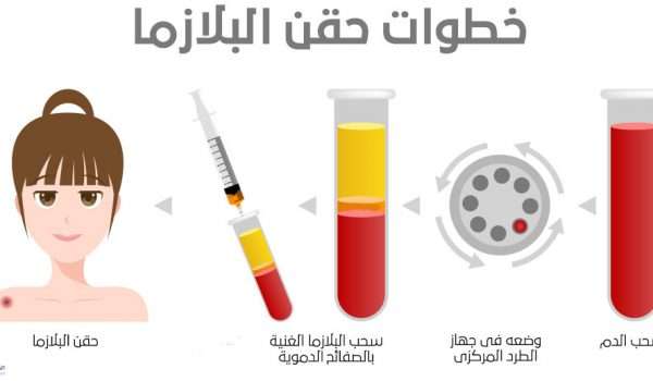 ما هي خطوات حقن البلازما ؟