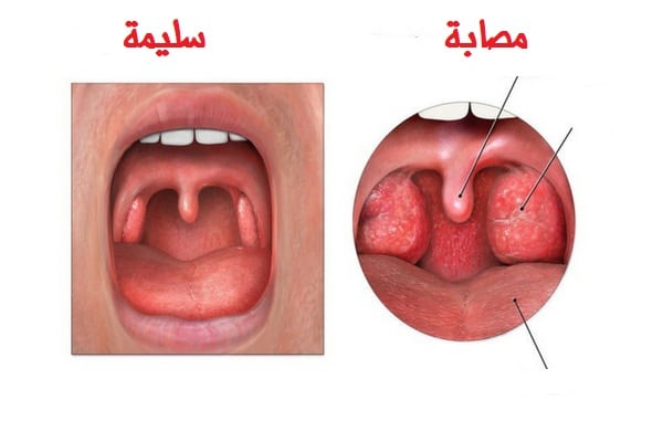 اعراض اللوز المصابة والسليمة