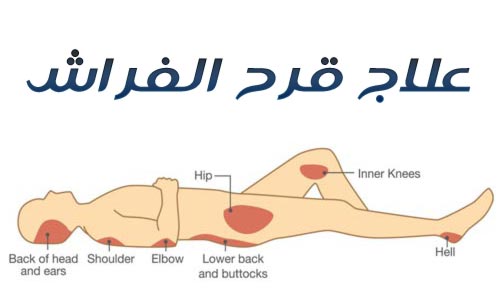 مراحل قرح الفراش وكيفية علاجها