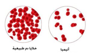  ما هو المقصود بالانيميا أو فقر الدم؟