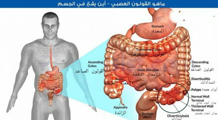 علاج القولون العصبي