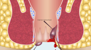 أسباب الإصابة بالبواسير وأهم أعراضها
