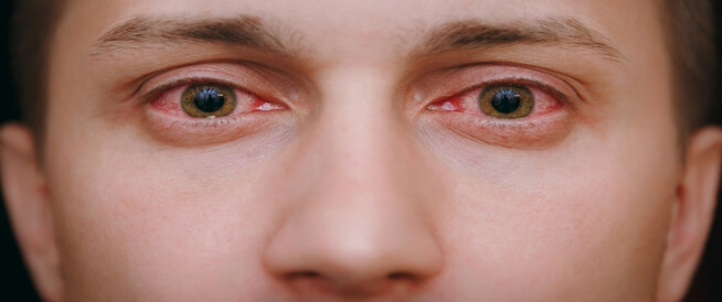 قطرة لـ علاج التهابات العين