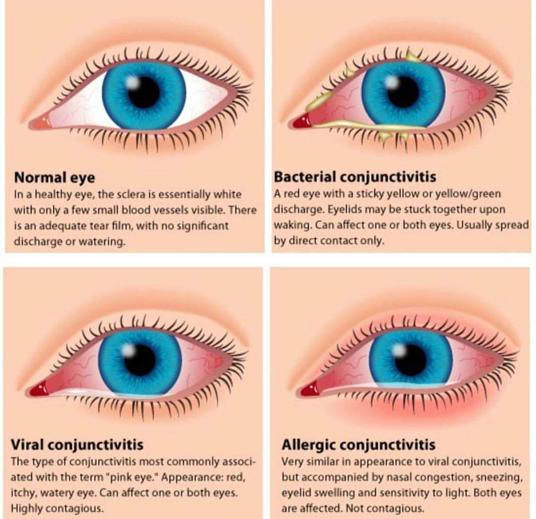 قطرة لـ علاج التهابات العين