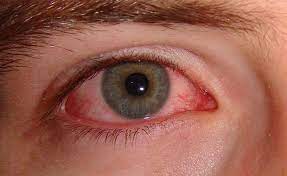 أعراض حساسية العين