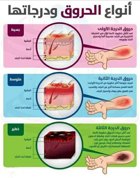 أنواع الحروق وكيفية التعامل معها