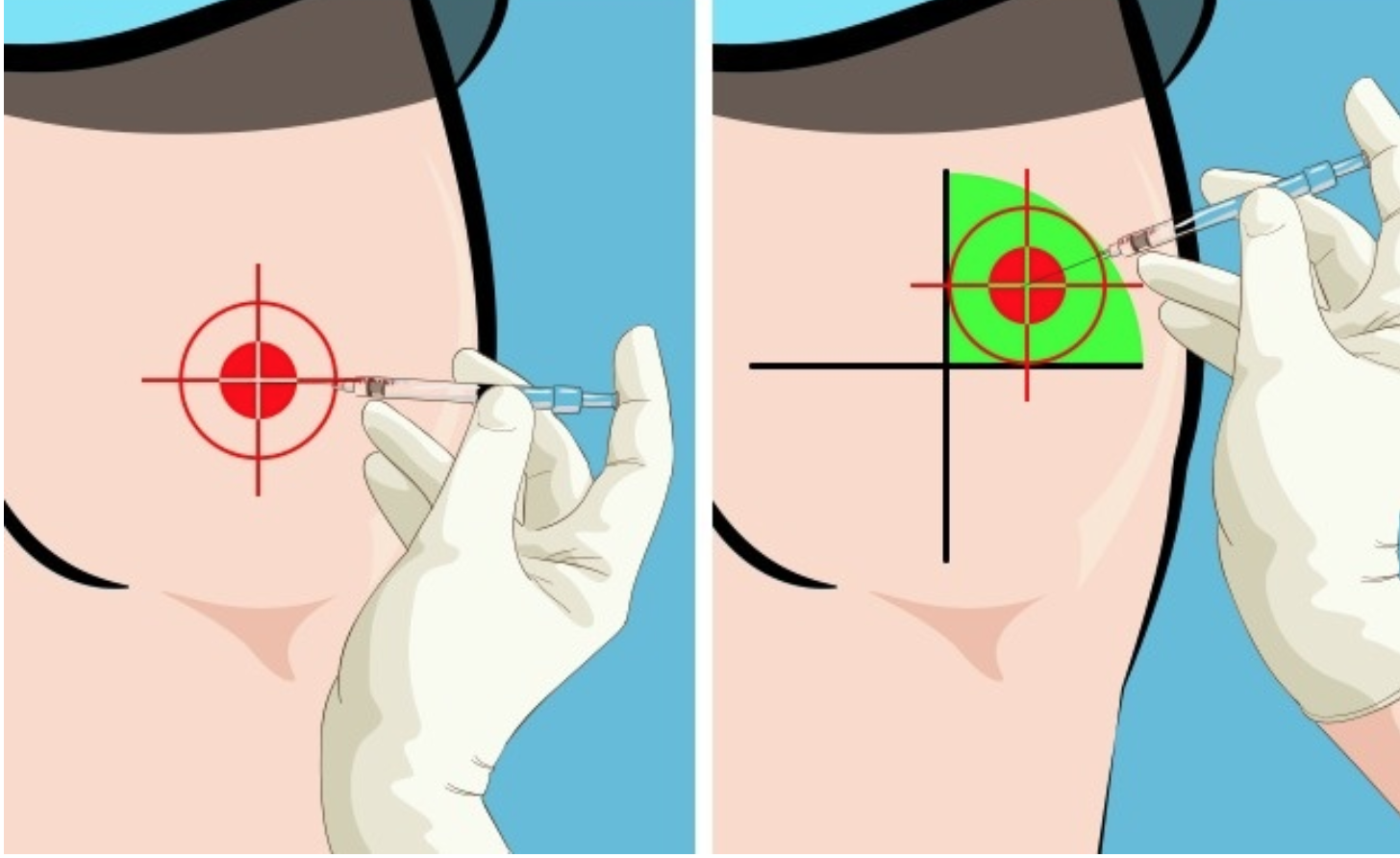 Как правильно делать внутримышечный укол. Как правильно колоть уколы внутримышечно. Как ставить укол в ягодицу в домашних условиях правильно. Как ставить уколы внутримышечно в ягодицу. Kak