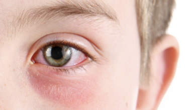 مرهم مضاد حيوي لعلاج حساسية والتهابات جفن العين