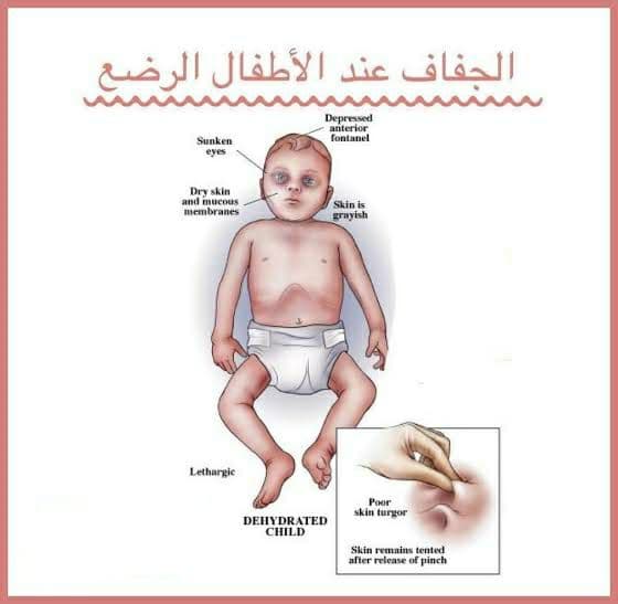 علاج الجفاف عند الأطفال