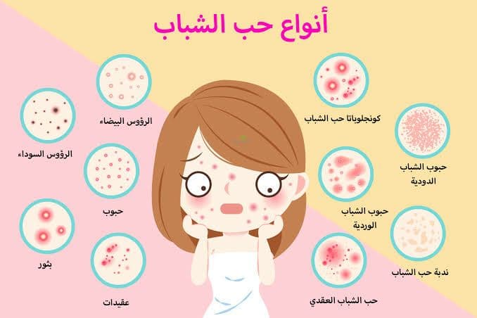 كريمات ومراهم لـ علاج حب الشباب