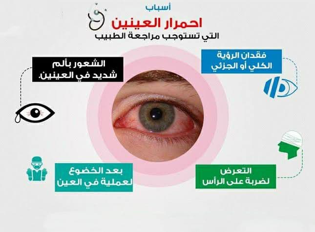 نقط لـ علاج أعراض احمرار العيون