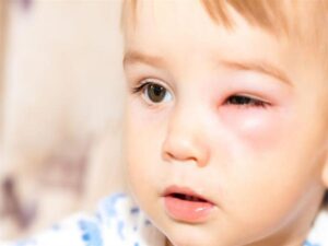 أسباب التهاب العين للأطفال