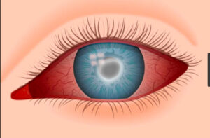 قطرة لـ العين تعالج أعراض التهاب العين البكتيري والفيروسي والفطري