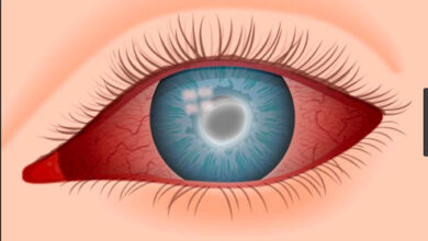 قطرة لـ العين تعالج أعراض التهاب العين البكتيري والفيروسي والفطري