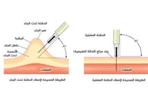 كيفية الحقن تحت الجلد وأنواع زوايا الحقن المختلفة والفرق بين الحقن تحت الجلد والحقن العضلي