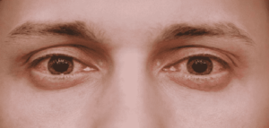 الأعراض المصاحبة لحساسة العين