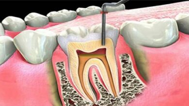 علاج التهاب عصب الاسنان