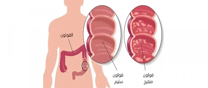 طرق علاج القولون التقرحي