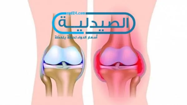 أسباب الخشونة أعراض خشونة الركبة