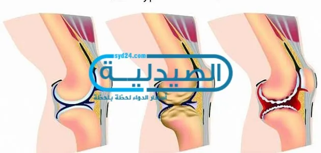 أسباب الخشونة أعراض الخشونة