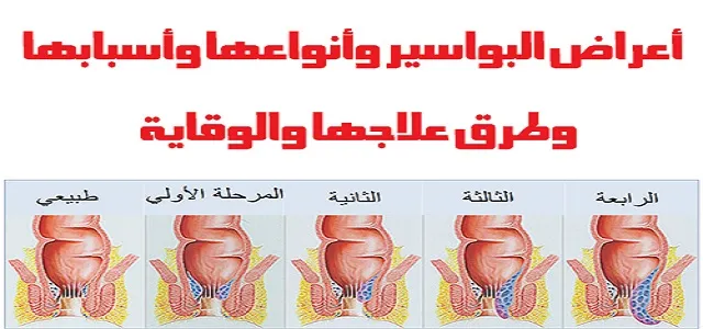 البواسير مراحل وأنواع وأعراض البواسير والشرخ الشرجي