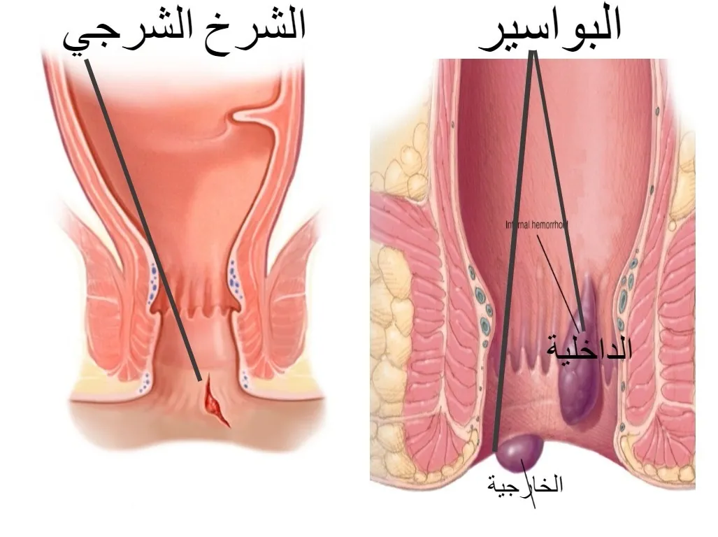 البواسير مراحل وأنواع وأعراض البواسير والشرخ الشرجي