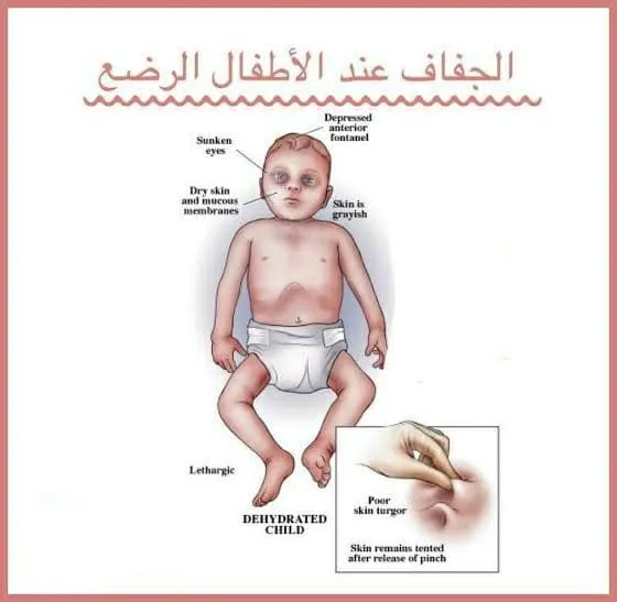 علاج الجفاف عند الأطفال